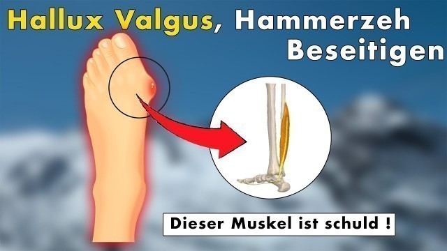 '3 Übungen gegen Hallux Valgus, Hammerzeh, Ballenzeh | Die WAHRE Ursache & Lösung'