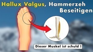 '3 Übungen gegen Hallux Valgus, Hammerzeh, Ballenzeh | Die WAHRE Ursache & Lösung'