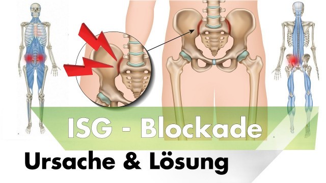 'ISG Blockade | Symptome, Ursachen & Lösung durch Training'