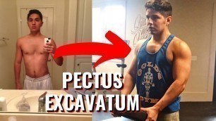 '3-Month Pectus Excavatum Workout Transformation (Rich Piana Bigger By The Day Challenge)'