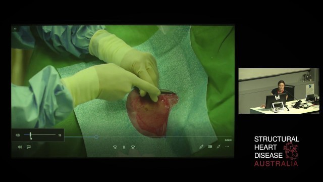 'Live Case of Right Heart Catheterisation using Dynamic Exercise - Dr Katrina Adorini'